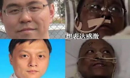 Due medici cinesi colpiti dal Coronavirus si risvegliano dopo un mese con la pelle scura!