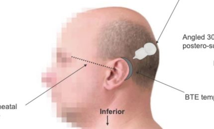 Sordit&agrave; grave, anche a Palermo gli impianti cocleari