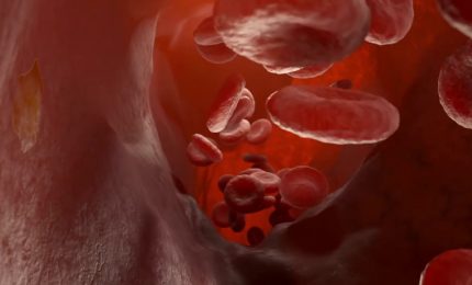 Emofilia, profilassi fitusiran riduce sanguinamenti del 61%