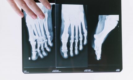 Ortopedia, le fratture non sono tutte uguali