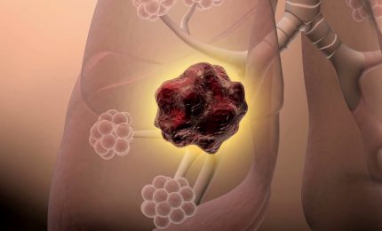 Tumore polmone, studio conferma benefici inibitore TKI