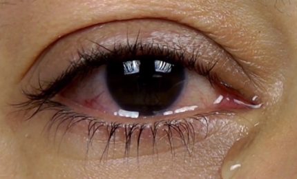 Cornea, in Italia 2 mila infezioni da funghi ogni anno