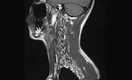 Tumori dell'orofaringe in aumento, i segnali da non sottovalutare