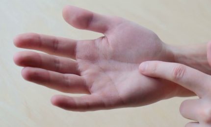 Sindrome del tunnel carpale, ecco chi &egrave; pi&ugrave; a rischio