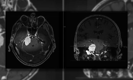Meningiomi, i sintomi da tenere d'occhio