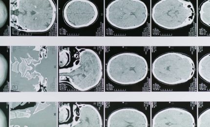 Glioblastoma, le molecole naturali migliorano la chemioterapia