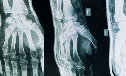 Artrite e artrosi, come riconoscerle e curarle