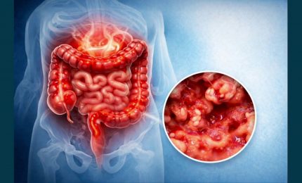 Colite ulcerosa, nuove opzioni terapeutiche