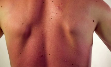Tumori cutanei non melanoma, ecco cosa sono. E occhio all'esposizione al sole